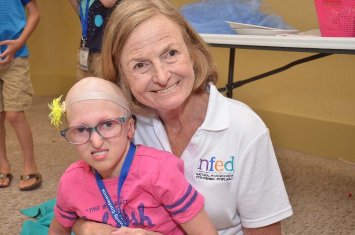 Mary holds a young girl with ectodermal dysplasia on her lap. The girl doesn't have hair but is wearing a headband with a yellow flower on it.