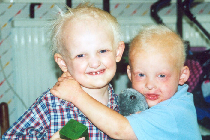 Two young boys are shown who are affected by XLHED. Both have sparse, white blonde hair. The boy on the left is missing teeth. The boy on the right, who has his arm around the other boy, has a face red from eczema.