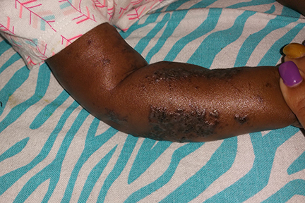 This is a picture of an arm of a baby with black skin that has a rash from IP.