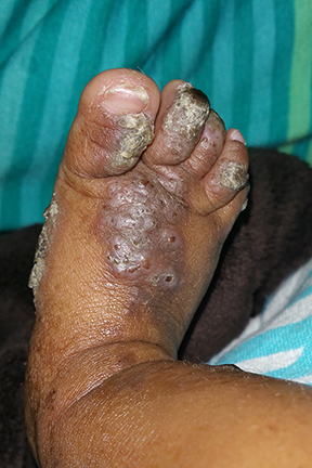 This is the photo of a black baby girl's foot covered in skin rashes caused by incontinentia pigmenti.