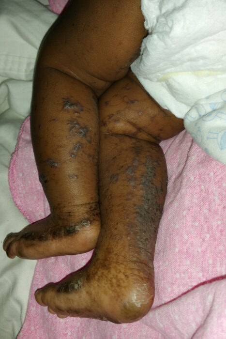 This photos shows the back of the legs of a baby who has black skin and has a rash from incontinentia pigmenti.