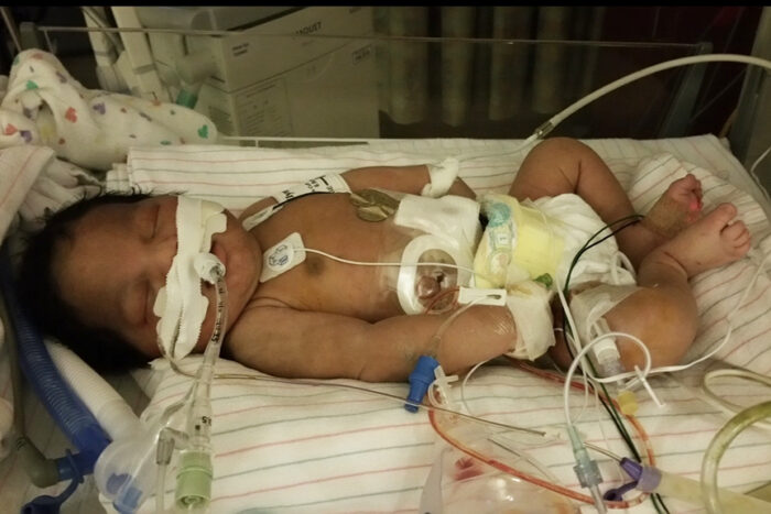 A newborn baby with black skin and hair is in a hospital bed with numerous tubes in her. She's living with incontinentia pigmenti.