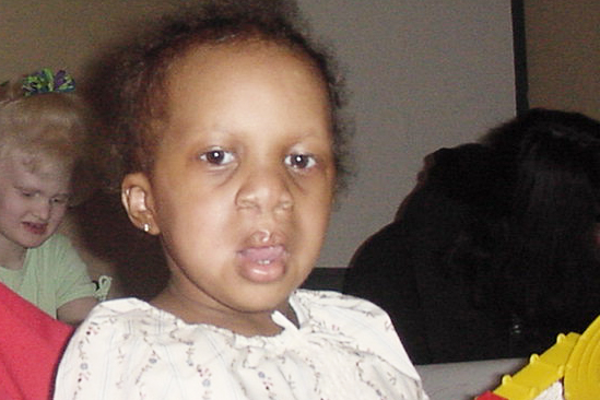 Headshot of a toddler who is affected by AEC syndrome. She has a curly Afro.