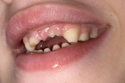 This is an intra-oral photo of a young girl's mouth. The front adult tooth is beginning to erupt. Other teeth are misshapen due to TSPEAR-related ectodermal dysplasia.
