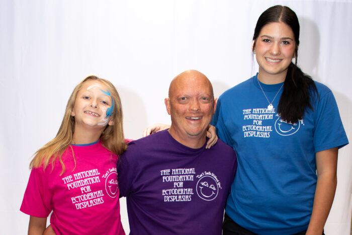 A man affected by x-linked hypohidrotic ectodermal dysplasia has his arms around his two daughters. They are wearing NFED shirts that say "We can't smile without you."